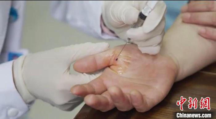 嘉善群眾體驗(yàn)小針刀?！〖紊平y(tǒng)戰(zhàn) 供圖